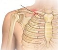 Диагностика и лечение сочетанных повреждений грудной клетки и конечностей
