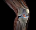 Повреждения синовиальной оболочки коленного сустава, клиника и лечение