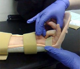 Клініко-електроміографічні та сонографічні критерії у визначенні тактики лікування хворих з ушкодженням периферичних нервів внаслідок травми кінцівок