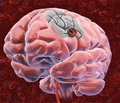 Аналіз демографічних даних та скарг хворих на цервікогенну вертебробазилярну недостатність мозкового кровообігу на ранній стадії захворювання