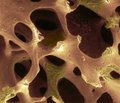 Керамопластика при лікуванні гігантоклітинних пухлин кісток