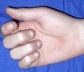 Роль ультрасонографии в диагностике сухожилий сгибателей кисти и пальцев